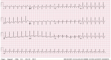 Taquicardia Ventricular Fascicular Anterior