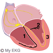 Bloqueo Bifascicular Anterior