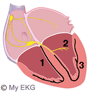 Bloqueo Bifascicular Posterior