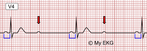 Bloqueo Auriculoventricular de Segundo Grado Tipo 2:1