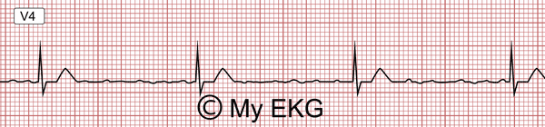 Fibrilación Auricular con Bloqueo Auriculoventricular Completo