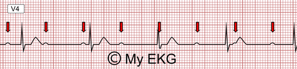 Bloqueo Auriculoventricular de Tercer grado, Bloqueo AV Completo