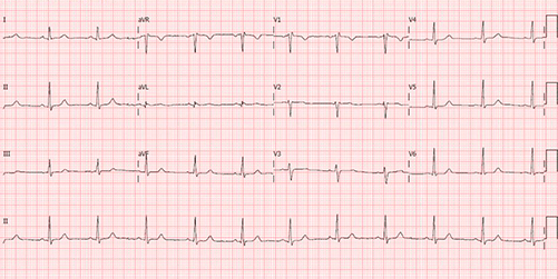 Electrocardiograma de Bloqueo Incompleto de Rama Derecha