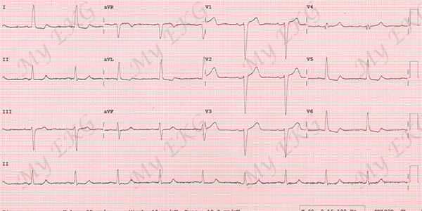 Electrocardiograma de Bloqueo Incompleto de Rama Izquierda