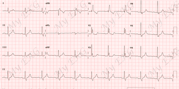 Electrocardiograma de Bloqueo de Rama Derecha