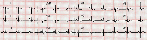 Electrocardiograma de Comunicación Interauricular tipo Ostium Secumdum