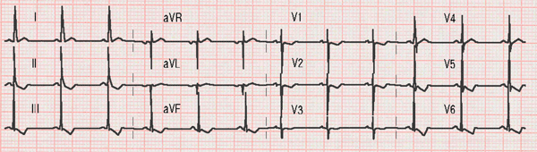 Electrocardiograma de Comunicación Interventricular