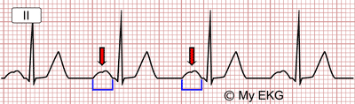 Electrocardiograma del Crecimiento Auricular Izquierdo