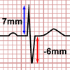 Cálculo del Eje Cardiaco, derivación ligeramente positiva