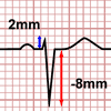 Cálculo del Eje Cardiaco, derivación negativa