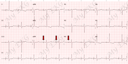 EKG con Estimulación Auricular por Marcapasos