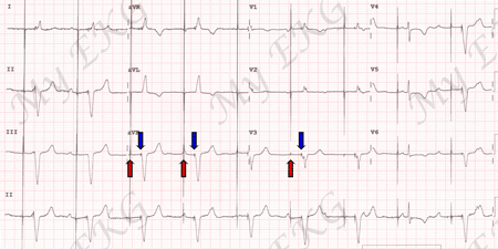 EKG con Estimulación por Marcapasos Bicameral