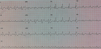 Electrocardiograma de Tromboembolismo Pulmonar