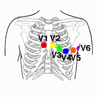 Electrodos Precordiales del Código de Colores de la AHA