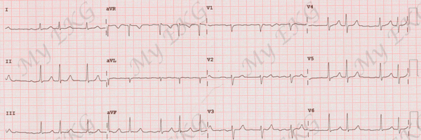 Fibrilación Auricular en el Electrocardiograma