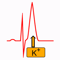 Hiperpotasemia y Electrocardiograma