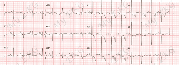 Electrocardiograma de Hipertrofia Ventricular Derecha