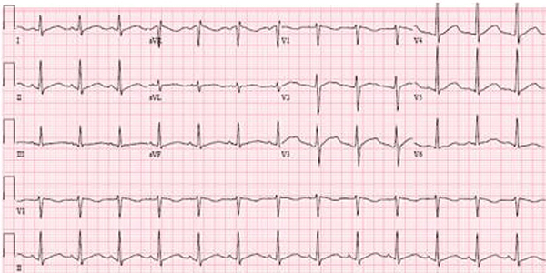 Hidroxicloroquina en el Electrocardiograma