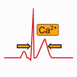 Hipercalcemia y Electrocardiograma