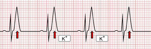 Hiperpotasemia en el EKG