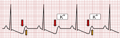 Hipopotasemia en el EKG