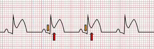 Pericarditis Aguda