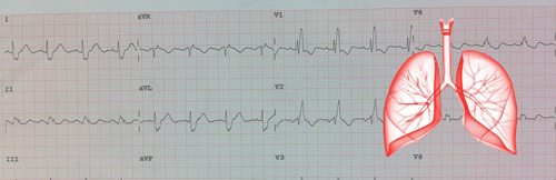 Tromboembolismo Pulmonar en el EKG