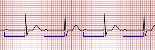 Bloqueo Auriculoventricular de Primer Grado