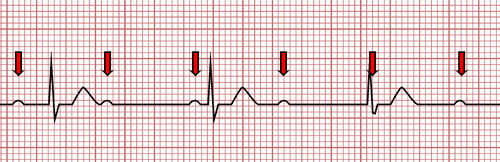 Bloqueo Auriculoventricular de Tercer Grado