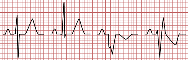 Morfologias del QRS