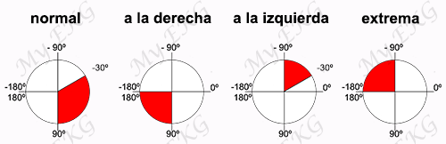 Cómo calcular el Eje Cardiaco