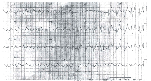 Cuarto Electrocardiograma del Examen MIR 2017