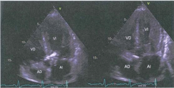 Quinta Imagen de Cardiología del Examen MIR 2018