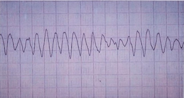 Séptima Imagen de Cardiología del Examen MIR 2018