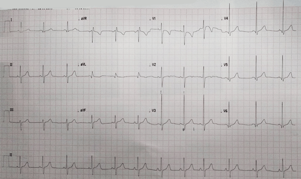 Electrocardiograma de Comunicación Interauricular tipo Ostium Primum</i>