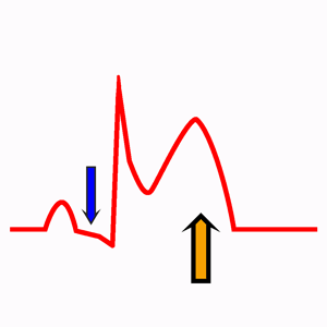 Pericarditis Aguda