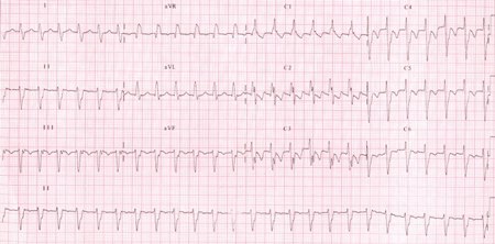 Taquicardia Ventricular Fascicular Posterior