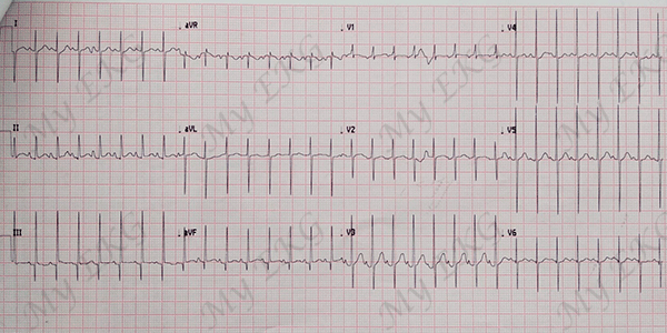 Electrocardiograma de la Tetralogía de Fallot