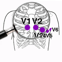 Trucos para colocar los Electrodos del Electrocardiograma