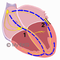 Anatomía del Wolff-Parkinson-White